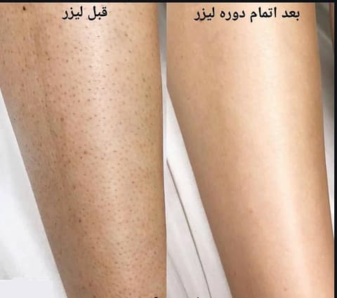 عوارض لیزر موهای زائد و راه‌های پیشگیری از آن