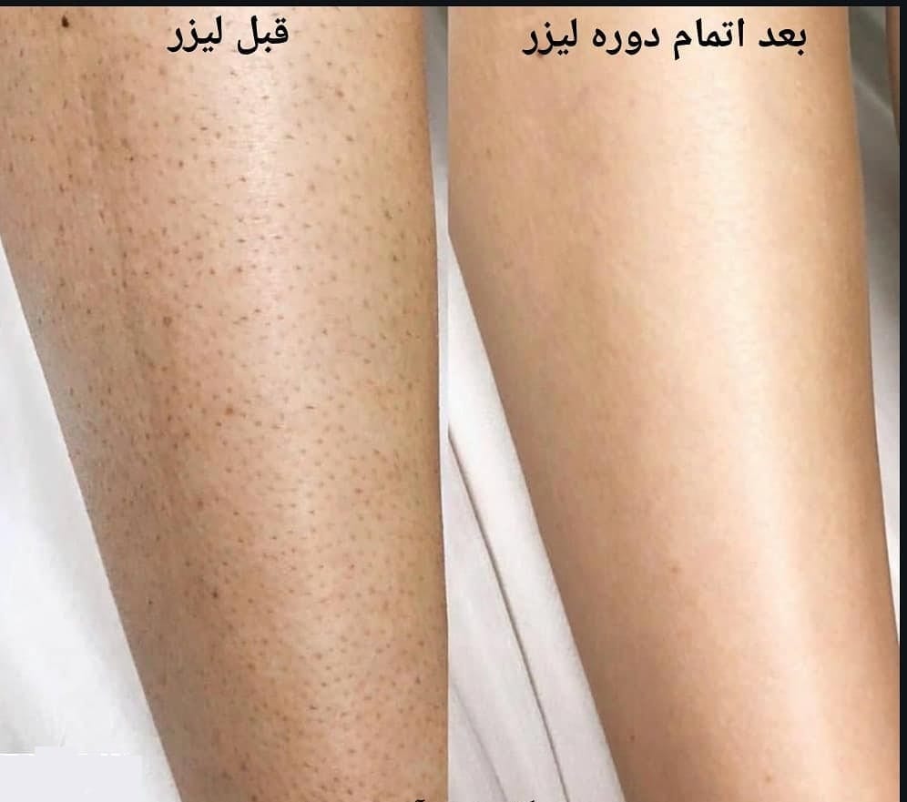 عوارض لیزر موهای زائد و راه‌های پیشگیری از آن