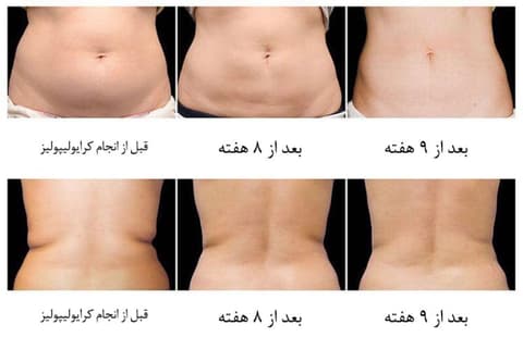 لاغری موضعی چیست و چه تفاوتی با ورزش و رژیم دارد؟