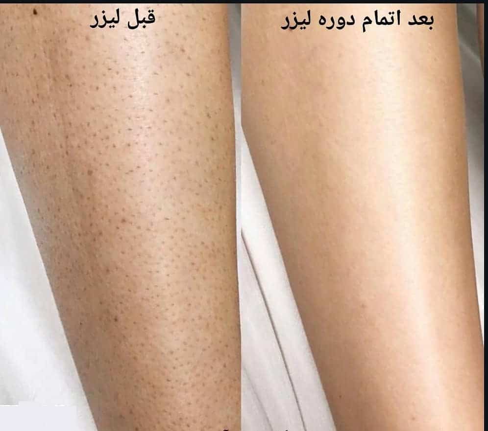 مرکز لیزر پیروزی