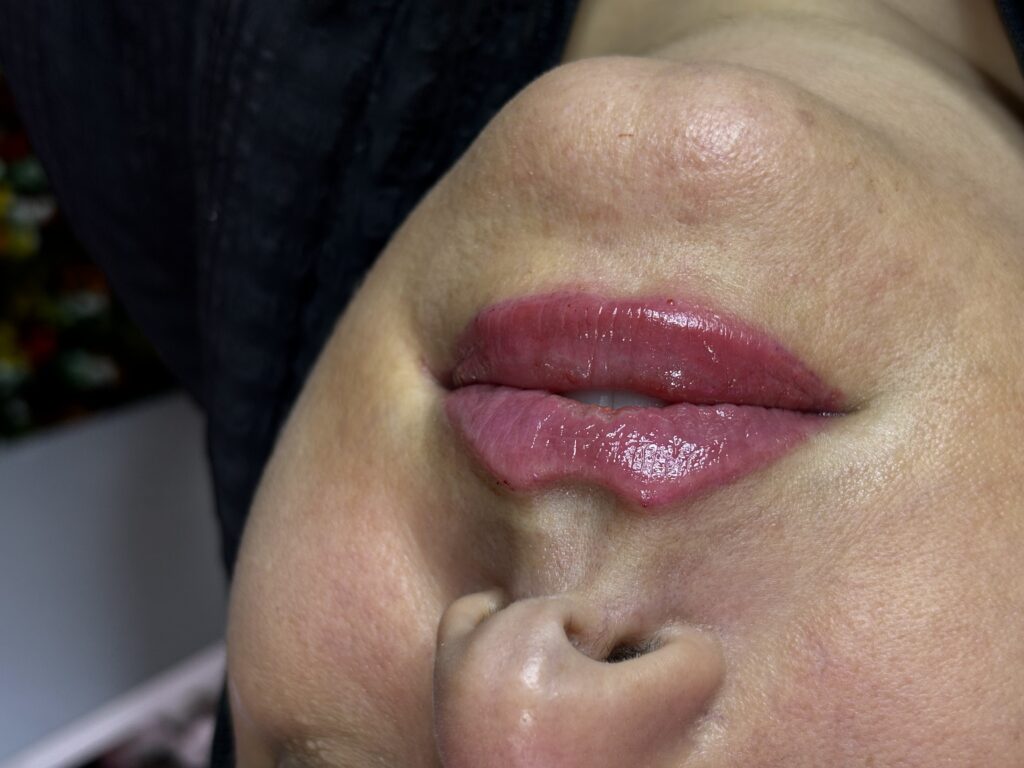 تزریق فیلر (ژل) صورت: راهنمای جامع برای گونه، چانه، زیر چشم، شقیقه و لب