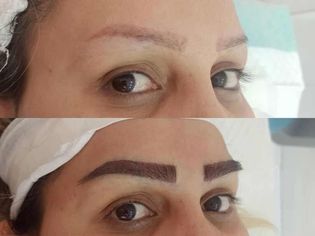 کاشت ابرو